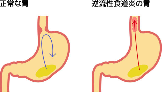 逆流性食道炎